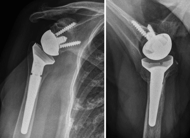 Üproteza inversa de umar